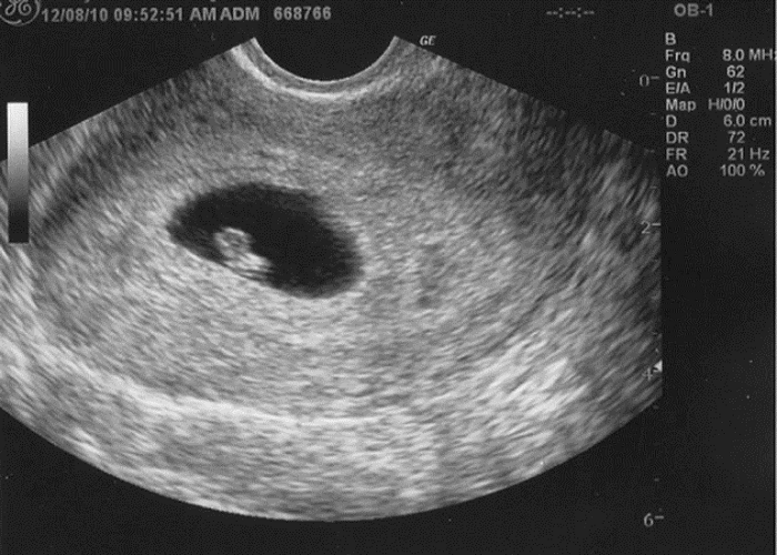 Tuần đầu thai kì cần siêu âm để xác định tình trạng mang thai và thai nhi đã làm tổ ổn định trong tử cung hay chưa